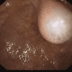 Uterine Cysts